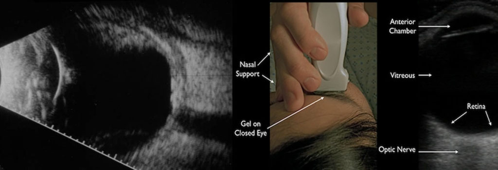 Ocular Imaging (Eye Ultrasound Or B-scan) - Radiology Nagpur